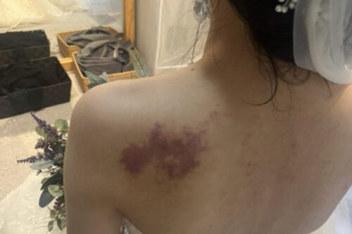 ボディメイクアップでタトゥーやアザを消す前